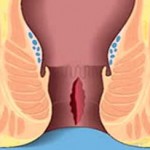 anal_fissur