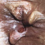 anal_fissur3