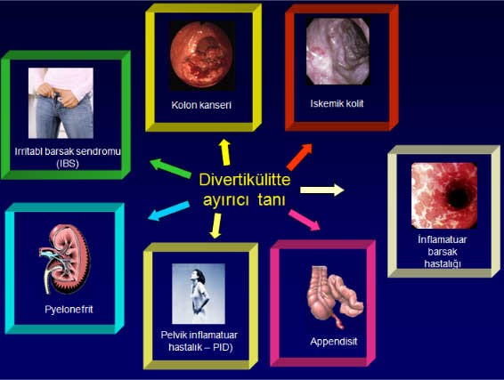 divertikulitayirici2