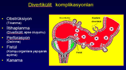 divertikulitkomplk