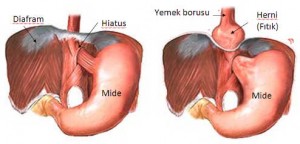 hiatal_herni4