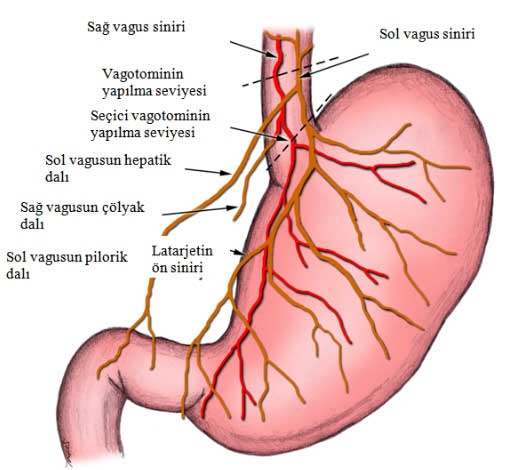 Gastroparezi1 Gastroparezi1