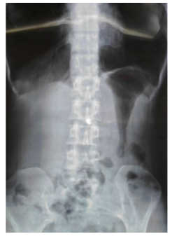 Gastroparezi2 Gastroparezi2