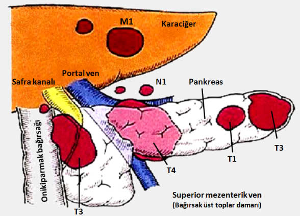 Pankreasca5
