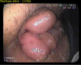 hemoroid