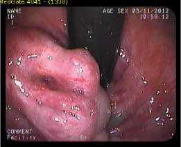 hemoroid2