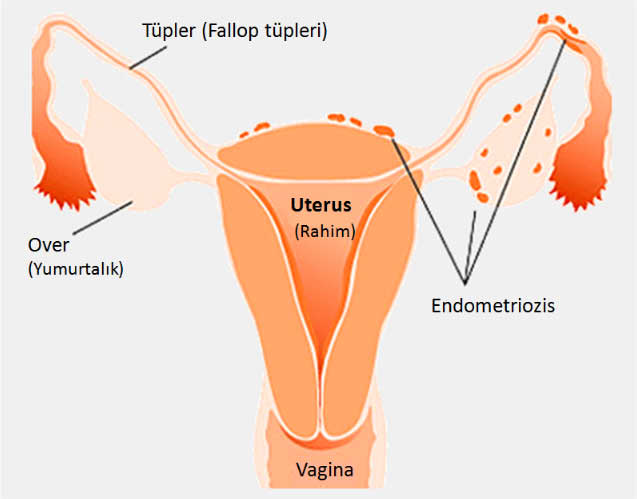 endometrio1